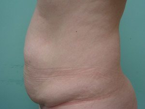 Tummy Tuck | 360 Body Lift Before & After case 17
