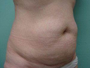 Tummy Tuck | 360 Body Lift Before & After case 17