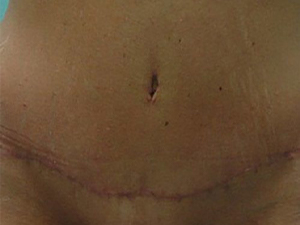 Tummy Tuck | 360 Body Lift Before & After case 19