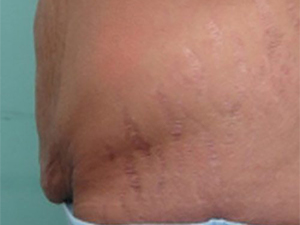 Tummy Tuck | 360 Body Lift Before & After case 19