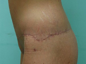 Tummy Tuck | 360 Body Lift Before & After case 19