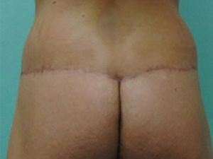 Tummy Tuck | 360 Body Lift Before & After case 19