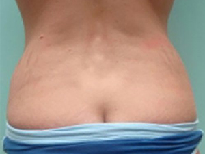 Tummy Tuck | 360 Body Lift Before & After case 19