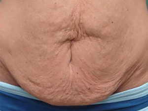 Tummy Tuck | 360 Body Lift Before & After case 19