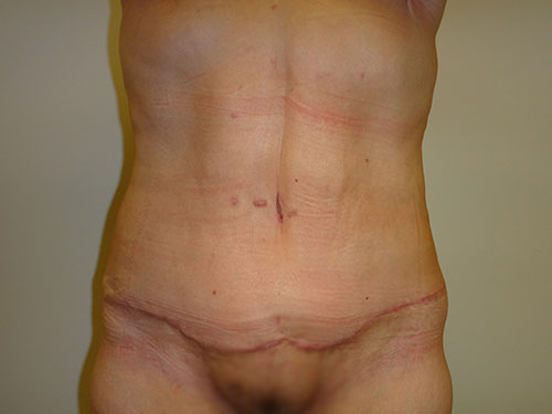Tummy Tuck | 360 Body Lift Before & After case 20