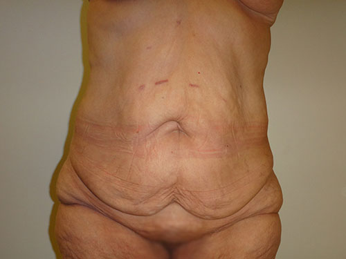 Tummy Tuck | 360 Body Lift Before & After case 20