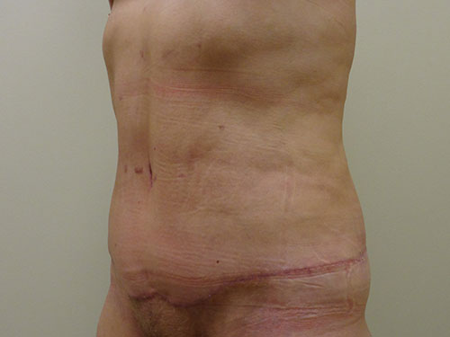 Tummy Tuck | 360 Body Lift Before & After case 20
