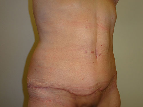 Tummy Tuck | 360 Body Lift Before & After case 20