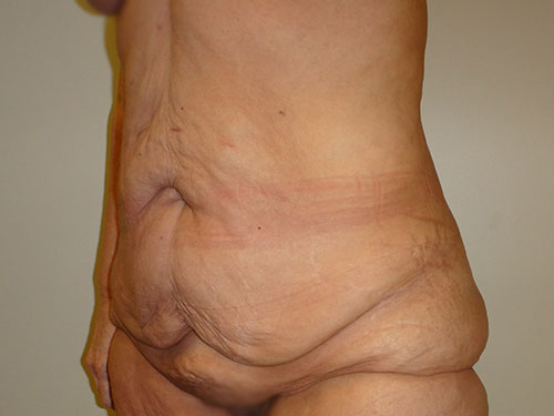 Tummy Tuck | 360 Body Lift Before & After case 20