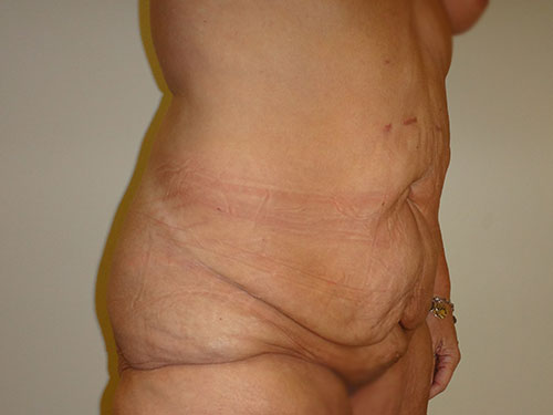 Tummy Tuck | 360 Body Lift Before & After case 20