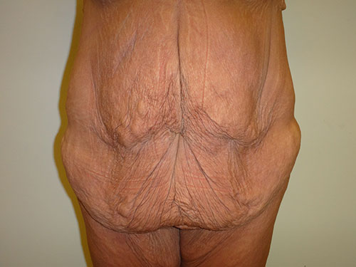 Tummy Tuck | 360 Body Lift Before & After case 21