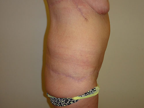 Tummy Tuck | 360 Body Lift Before & After case 21