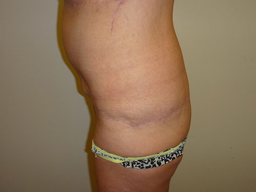 Tummy Tuck | 360 Body Lift Before & After case 21