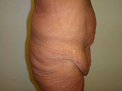 Tummy Tuck | 360 Body Lift Before & After case 21
