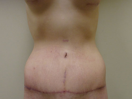 Tummy Tuck | 360 Body Lift Before & After case 22