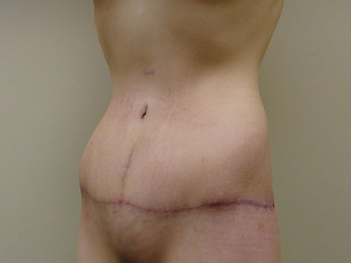 Tummy Tuck | 360 Body Lift Before & After case 22