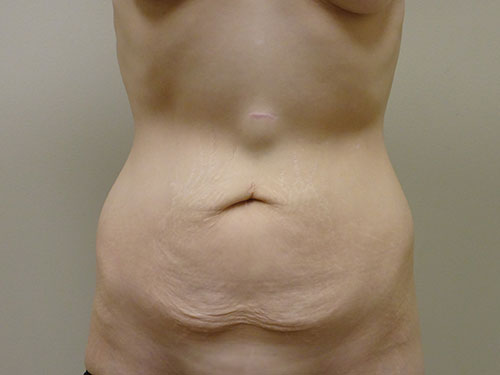 Tummy Tuck | 360 Body Lift Before & After case 22