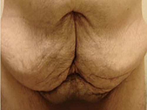Tummy Tuck | 360 Body Lift Before & After case 23