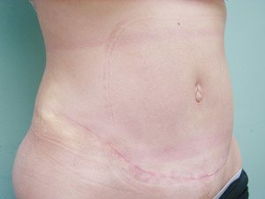 Tummy Tuck | 360 Body Lift Before & After case 24