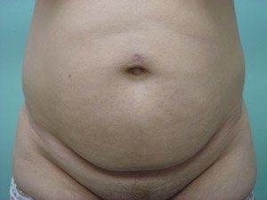 Tummy Tuck | 360 Body Lift Before & After case 24
