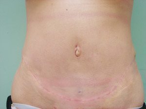 Tummy Tuck | 360 Body Lift Before & After case 24