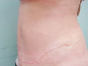 Tummy Tuck | 360 Body Lift Before & After case 24