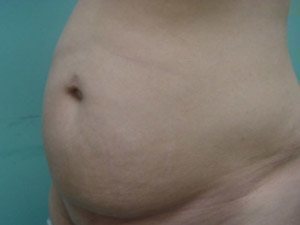 Tummy Tuck | 360 Body Lift Before & After case 24