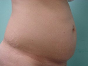 Tummy Tuck | 360 Body Lift Before & After case 24