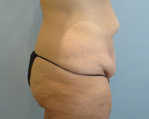 Tummy Tuck | 360 Body Lift Before & After case 25