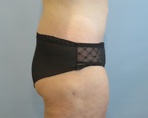 Tummy Tuck | 360 Body Lift Before & After case 25