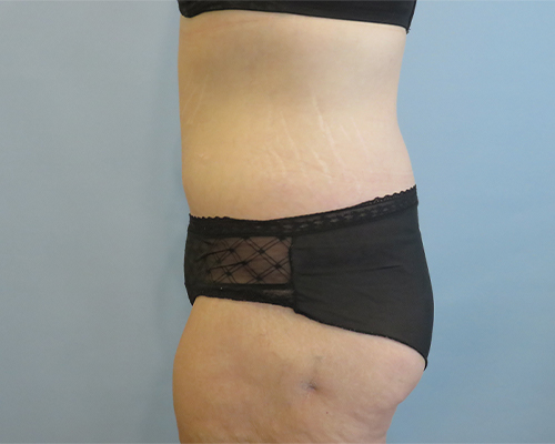 Tummy Tuck | 360 Body Lift Before & After case 25