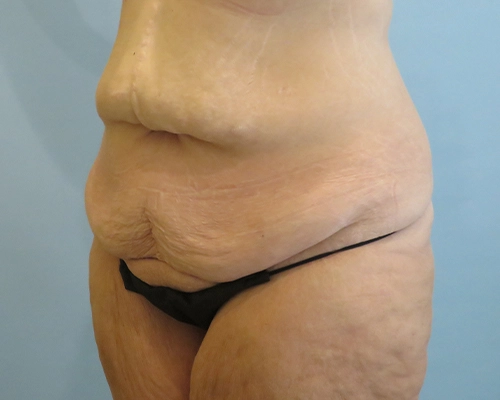 Tummy Tuck | 360 Body Lift Before & After case 25