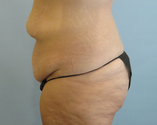 Tummy Tuck | 360 Body Lift Before & After case 25