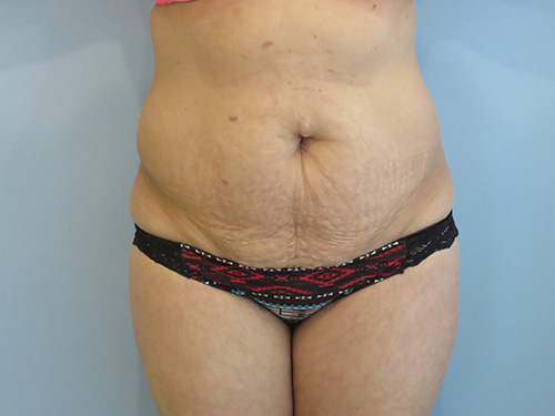 Tummy Tuck | 360 Body Lift Before & After case 6