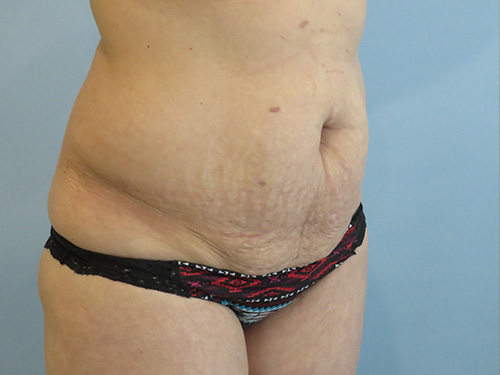 Tummy Tuck | 360 Body Lift Before & After case 6