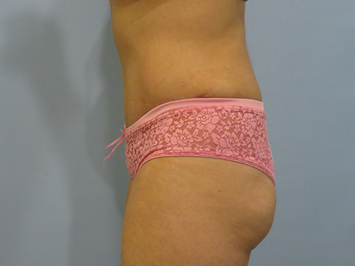 Tummy Tuck | 360 Body Lift Before & After case 6
