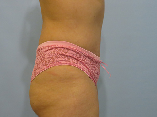 Tummy Tuck | 360 Body Lift Before & After case 6