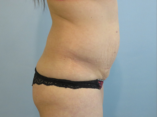 Tummy Tuck | 360 Body Lift Before & After case 6
