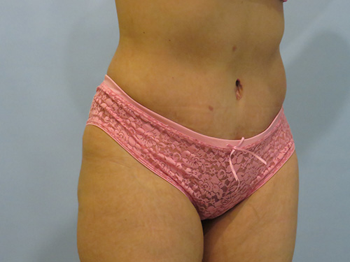 Tummy Tuck | 360 Body Lift Before & After case 6