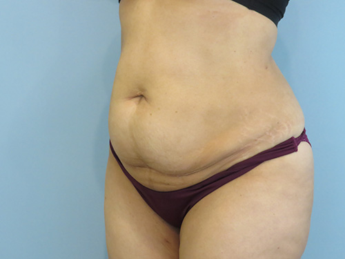 Tummy Tuck | 360 Body Lift Before & After case 8