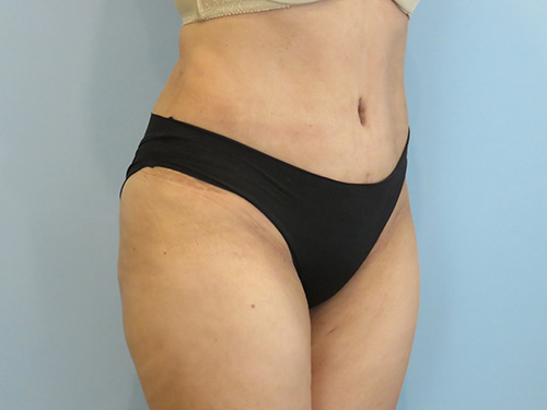 Tummy Tuck | 360 Body Lift Before & After case 8