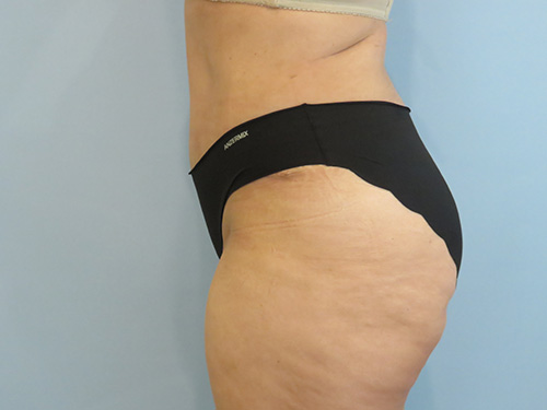Tummy Tuck | 360 Body Lift Before & After case 8