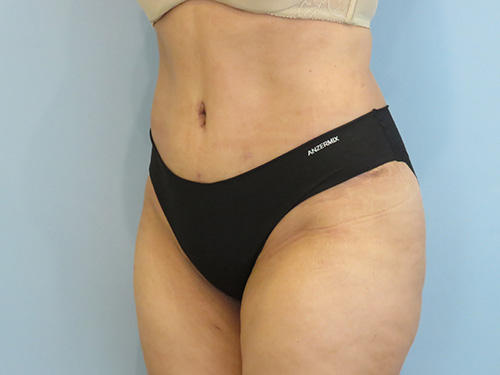 Tummy Tuck | 360 Body Lift Before & After case 8