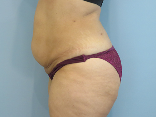 Tummy Tuck | 360 Body Lift Before & After case 8