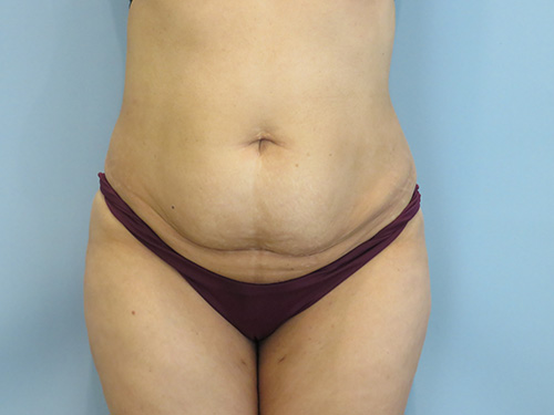 Tummy Tuck | 360 Body Lift Before & After case 8