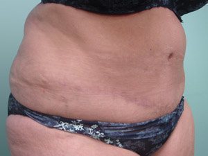 Tummy Tuck | 360 Body Lift Before and After case 18
