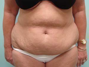 Tummy Tuck | 360 Body Lift Before and After case 18