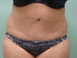 Tummy Tuck | 360 Body Lift Before and After case 18