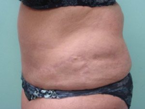 Tummy Tuck | 360 Body Lift Before and After case 18