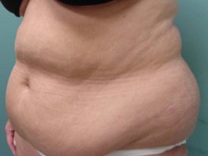 Tummy Tuck | 360 Body Lift Before and After case 18